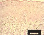 圖5：皮膚組織切片：表皮釘以下之真皮組織可見大量炎症細胞浸潤，以中性球為主。