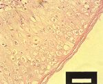 圖6：皮膚組織切片：棘細胞質腫大呈空泡化，內含大小不一的嗜酸性核內包涵體。