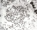 圖7：皮膚組織超薄切片：大量豬痘病毒團塊存在棘細胞之胞質內（長箭頭），在病毒團塊周圍可見許多微小管生成