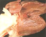 圖3：左心室外流道，主動脈瓣肥厚且與下處之心內膜發生明顯之纖維化，心內膜下之心肌亦發生壞死。