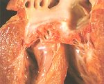 圖4：二尖瓣明顯畸形，瓣膜肥厚，頂端內捲形成如結節樣，腱索粗短無分枝且部分有融合起來，乳頭肌粗大且部分與瓣膜接觸。