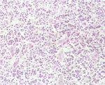 圖3：濃染的腫瘤細胞呈瀰漫性浸潤於肝組織中，大部份肝細胞均已消失，僅殘存少部份的肝細胞。