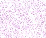 圖4：腫瘤細胞大多為含有較豐富的細胞質，大而淡染且有明顯核仁的大型淋巴球。有絲分裂頗普遍，間質少而纖細。