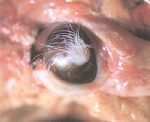 圖5：眼球角膜上有皮膚樣囊腫並有毛髮生長。