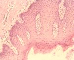 圖2：口唇部皮膚表皮棘細胞層細胞增殖並有角化不全現象。
