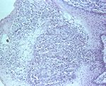 圖3：棘細胞層細胞增殖，水腫變性，氣球樣變性。