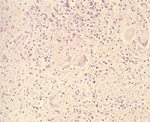 圖5：高倍下，可見藍罕氏巨細胞之細胞核呈花圈狀或馬蹄狀排列，而周圍則是由巨噬細胞變形而成的類上皮細胞。