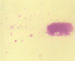 圖7：分離之細菌作成抹片，不易塗開 ( 因菌體外有蠟質 )。經抗酸染色，可見呈紅染之長桿菌。