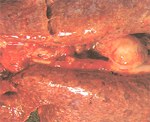圖4：縱膈淋巴腫大，肺實質密發紅白色大小不一結核結節。