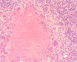 圖7：腸間淋巴組織切片: 典型肉芽腫病變，凝固樣壞死區周圍由大量類上皮細胞、藍罕氏巨細胞及纖維結締組織包被。