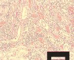 圖4：腎組織切片：間質性腎炎，大量單核球瀰漫性浸潤於腎間質，腎小管擴張，粉紅色玻璃樣圓柱存於管腔內。