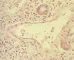 圖5：腎組織切片：腎小管擴張，上皮細胞扁平化，周圍大量炎量細胞浸潤，以單核球為主。