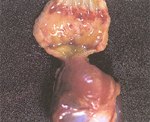 圖2：腺胃與嗉囊交接處粘膜呈帶狀出血。