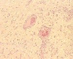 圖4：大腦組織切片：可見淋巴球圍管血管內皮細胞增生，及神經膠細胞增殖聚集等病變。