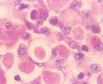 圖4：肝細胞內大小不一嗜伊紅性蟲體。