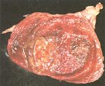 圖3：膀胱粘膜瀰漫性充血化膿。