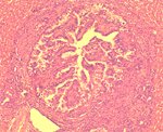 圖3：膽管上皮細胞增生及肉芽腫組織病變圍繞著膽管並有許多炎症細胞浸潤。