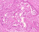 圖3：本腫瘤上皮細胞具有清楚的核及核仁和豐富的細胞質，而且可見細胞分絲分裂的情形。