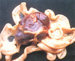 圖1：腸繫膜上可見一 6 × 6 公分大小暗紅色鬆軟腫塊。