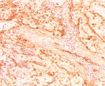 圖4：以 Factor Ⅷ Rel. Ag 單株抗體經 ABC 染色後，腫塊組織內腔竇狀結構內襯之上皮細胞有棕色陽性反應。