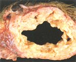 圖1：乳腺腫大、實質部增厚，腺體中央壞死並呈空洞化。