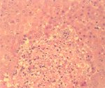 圖4：病豬肝組織切片：於壞死灶周圍可見嗜酸性核內包涵體。