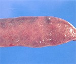 圖3：脾周邊組織呈暗紅色小區域突起，隔一段時間後，此小突起會消失，與豬瘟之脾梗塞不同，臨床上需注意類症鑑別。