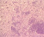圖5.淋巴結組織切片: 淋巴球顯著減少，少數淋巴濾胞殘留，疏鬆組織間隙有嗜酸性球浸潤。