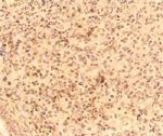 圖4：感染豬隻肺臟，經ABC染色後，於變性腫脹之肺泡巨噬細胞的細胞質中可見棕色陽性反應。