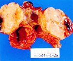 圖3：腫大之腸間淋巴切面可見局部出血及黃白色光滑肉樣組織，髓質及皮質之界限不明。