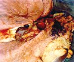 圖1：肺隔葉上方近肋膜面，有一約 20 × 30 cm 面積，含多個紅色乳突狀突起之結節。