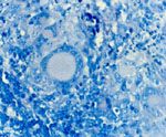 圖4：抗酸性染色：數個獨立個體之紅色短桿菌於病灶區之藍罕氏巨細胞內。