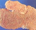 圖2：迴盲腸交界處腸管黏膜肥厚、皺褶著增生、有如洗衣板樣條紋。 