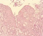 圖3：迴盲腸組織切片 :腸粘膜面增厚、許多藍染細胞聚集其中，腸粘膜失去正常之排列。