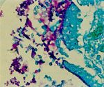 圖4：胃黏膜糜爛區可見白色念珠菌之偽菌絲與孢子