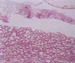 圖2：肺表面外覆一層纖維及炎症細胞。H & E stain × 100