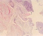 圖２：滑膜囊疣狀物組織切片：絨毛上皮細胞增生，向囊腔外突出（箭頭） 