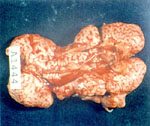 圖1：腎臟腫大 2 至 3 倍，且實質組織內含有尿酸鹽的沈積。