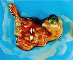 圖4：檢體做成乳劑，經連串程序接種 10 日齡雞胚胎尿囊腔內，於 16 日齡後，可見胚胎的捲曲、矮小，生長中止等病變。