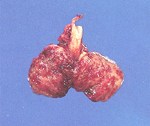 圖2：肺多發局部肉芽腫。