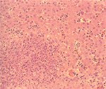 圖3：肝組織切片:多發局部壞死灶，凝固樣壞死區內可見細胞碎片、菌塊及異嗜球。