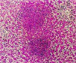 圖3：肝細胞腫脹，局部壞死灶明顯，內含大量壞死細胞核碎片及異嗜球。