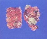 圖1：肺臟漿膜面及實質皆有黃白色結節病灶分佈