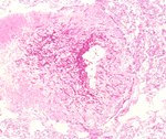 圖3：肺臟有乾酪樣壞死灶形成的肉芽腫病變，壞死區有黴菌絲分佈，周圍則為結締組織包被。