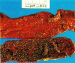 圖2：腸黏膜嚴重出血，表面附著砂粒樣偽膜。