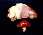 圖3：心肌呈現較廣區域的白濁片狀病變。