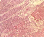 圖4：橫紋肌、肌纖維呈廣泛性的變性、具粉紅色均質樣變性、橫紋消失、斷裂，部份肌纖維溶解；肌束間隙擴大內含有少量均質樣液體及衛星細胞浸潤