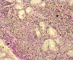 圖2：在睪丸之部分區域可見許多曲細精管管腔中充滿腫瘤細胞。