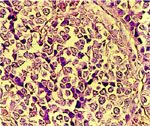 圖4：腫瘤細胞呈多角形，分裂相當旺盛，核圓且大小不一，核仁清楚，為精細胞瘤之腫瘤細胞。