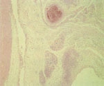 圖3：腸漿膜肥厚、附著纖維素滲出物、大量單核球浸潤呈淋巴集結樣排列，另可見血管炎及血栓形成等病變。H&E stain × 50